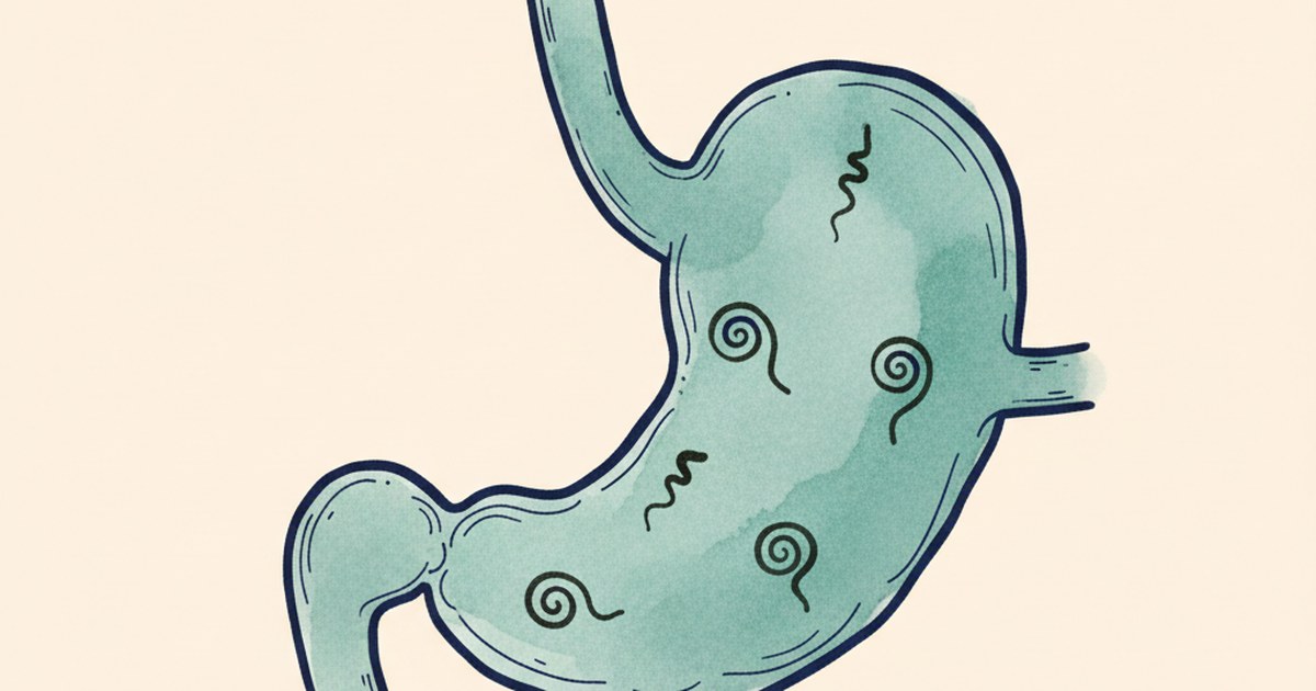 Editorial watercolor of a J-shaped stomach with H. pylori marker.